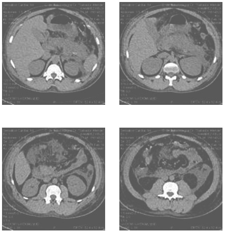 pancreatitis_aguda_edematosa/TAC_pancreas_ascitis