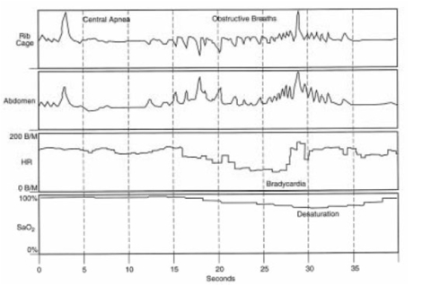 pausas_de_apnea/apnea_ mixta