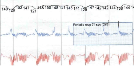 pausas_de_apnea/respiracion_periodica