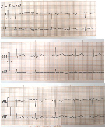 situs_inversus_caso/ECG_EKG_electrocardiograma