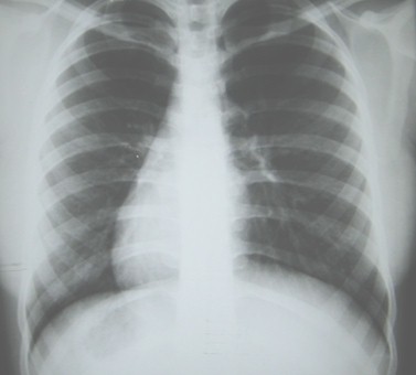 situs_inversus_caso/clinico_radiografia_torax