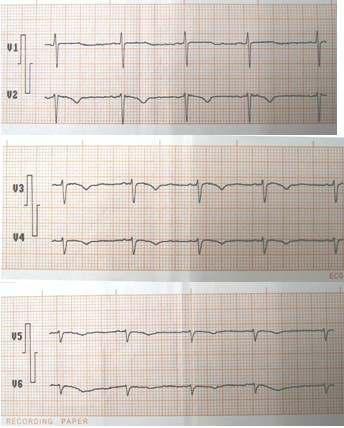 situs_inversus_caso/eje_electrico_derecha