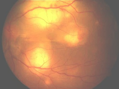 tuberculosis_ocular_ADA/coroiditis_tuberculosa_TBC