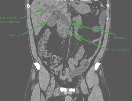 tumor_pancreas_caso/clinico_TAC_abdomen