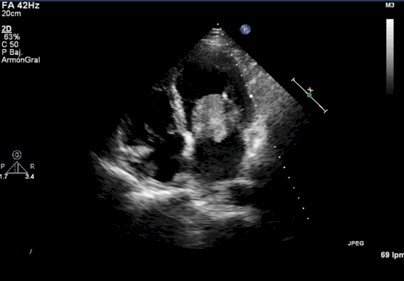 disfagia_mixoma_auricular/caso_clinico_masa