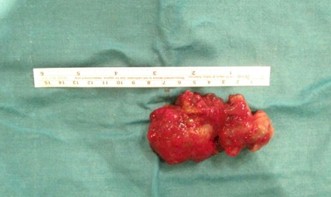 disfagia_mixoma_auricular/dimensiones_tumoracion_cardiaca