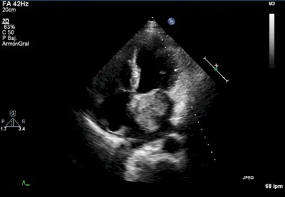 disfagia_mixoma_auricular/ecocardiograma_ecocardiografia_tumor