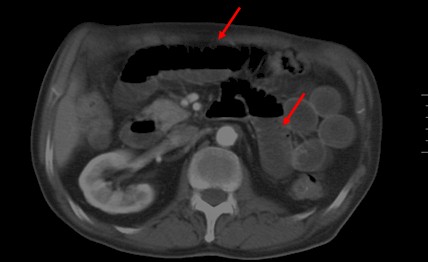 perforacion_intestinal_espina/TAC_dilatacion_asas_intestinales perforacion_intestinal_espina/TAC_dilatacion_asas_intestinales