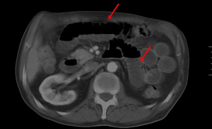 perforacion_intestinal_espina/TAC_dilatacion_asas_intestinales