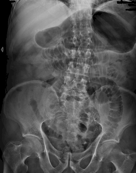 perforacion_intestinal_espina/dilatacion_estomago_rx_abdomen