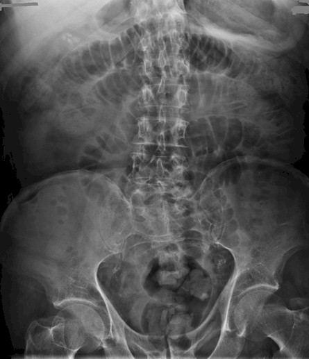 perforacion_intestinal_espina/dilatacion_intestino_delgado_rx perforacion_intestinal_espina/dilatacion_intestino_delgado_rx