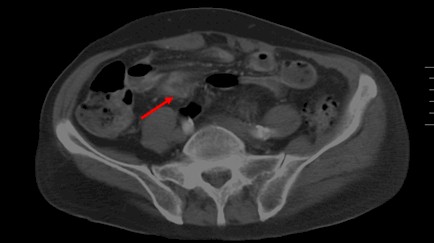 perforacion_intestinal_espina/engrosamiento_parietal_intestino