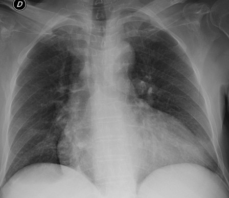 perforacion_intestinal_espina/rx_torax_normal perforacion_intestinal_espina/rx_torax_normal