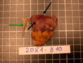 perforacion_intestinal_espina/yeyuno_perforado_AP perforacion_intestinal_espina/yeyuno_perforado_AP