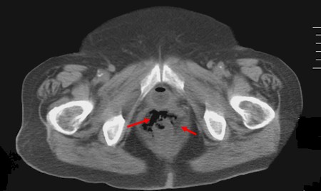 perforacion_rectal_sonda/TAC_aire_perianal