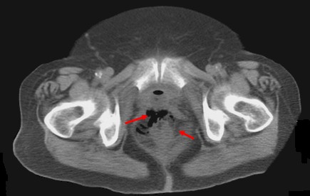 perforacion_rectal_sonda/TAC_liquido_perianal