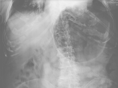 volvulo_gastrico_agudo/aspiracion_contenido_gastrico volvulo_gastrico_agudo/aspiracion_contenido_gastrico