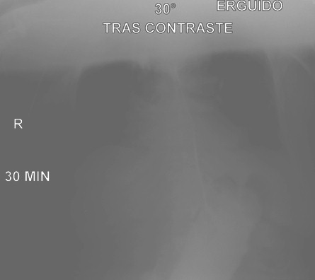 volvulo_gastrico_agudo/transito_gastroduodenal_contraste volvulo_gastrico_agudo/transito_gastroduodenal_contraste