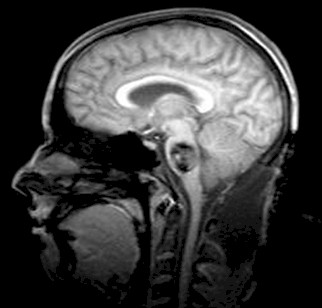 anestesia_cavernoma_protuberancial/tumor_cerebral_RMN anestesia_cavernoma_protuberancial/tumor_cerebral_RMN