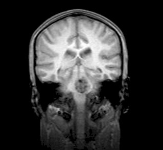 anestesia_cavernoma_protuberancial/tumoracion_intracraneal_RMN