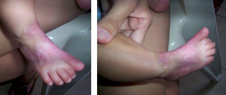 aplasia_cutis_congenita/evolucion_favorable_lesiones aplasia_cutis_congenita/evolucion_favorable_lesiones