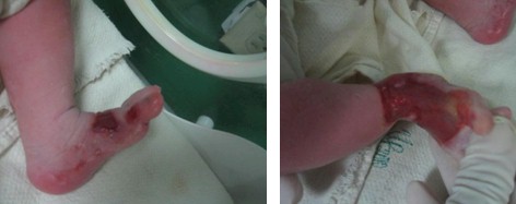 aplasia_cutis_congenita/recien_nacido_lesiones aplasia_cutis_congenita/recien_nacido_lesiones