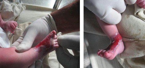 aplasia_cutis_congenita/semiinjerto_piel_cerdo aplasia_cutis_congenita/semiinjerto_piel_cerdo