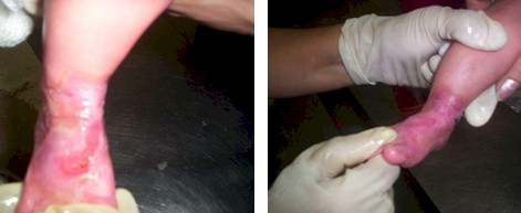 aplasia_cutis_congenita/semiinjerto_piel_sintetica aplasia_cutis_congenita/semiinjerto_piel_sintetica