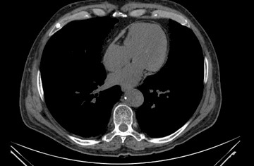 ascitis_artritis_reumatoide/TAC_pericarditis_constrictiva ascitis_artritis_reumatoide/TAC_pericarditis_constrictiva