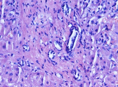 ascitis_artritis_reumatoide/hepatitis_portal_inespecifica ascitis_artritis_reumatoide/hepatitis_portal_inespecifica