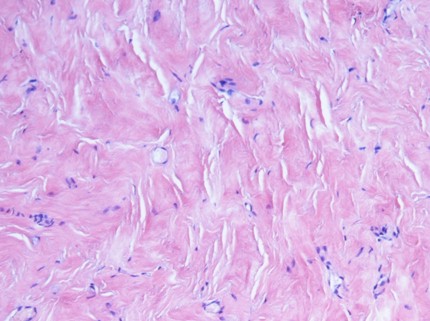 ascitis_artritis_reumatoide/pericarditis_constrictiva_cronica ascitis_artritis_reumatoide/pericarditis_constrictiva_cronica