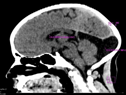 complejo_Dandy-Walker/TAC_cerebral_craneal complejo_Dandy-Walker/TAC_cerebral_craneal