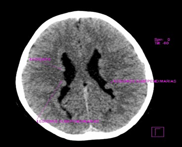 complejo_Dandy-Walker/compresion_hemisferio_cerebeloso complejo_Dandy-Walker/compresion_hemisferio_cerebeloso