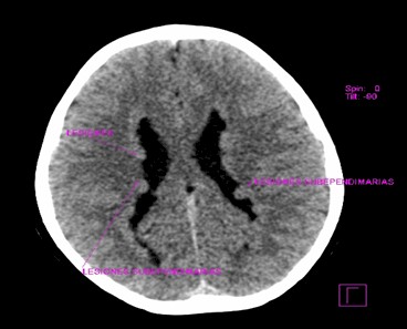 complejo_Dandy-Walker/compresion_hemisferio_cerebeloso