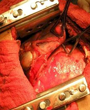 diabetes_absceso_pulmonar/cirugia_toracica_paquipleuritis diabetes_absceso_pulmonar/cirugia_toracica_paquipleuritis