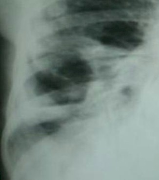 diabetes_absceso_pulmonar/rx_radiografia_paquipleuritis