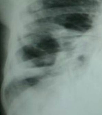 diabetes_absceso_pulmonar/rx_radiografia_paquipleuritis diabetes_absceso_pulmonar/rx_radiografia_paquipleuritis