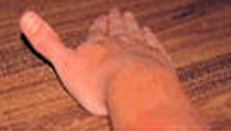 herida_incisa_mano/tendones_extensores_exploracion herida_incisa_mano/tendones_extensores_exploracion