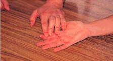 herida_incisa_mano/tendones_flexores_profundos herida_incisa_mano/tendones_flexores_profundos