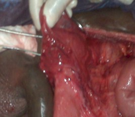 hernia_inguinal_estrangulada/tratamiento_quirurgico_cirugia