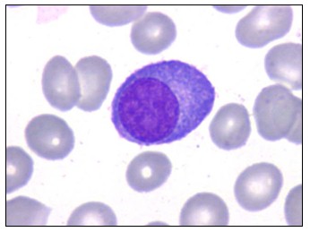 mieloma_multiple_gammapatia/celula_plasmatica_microscopio mieloma_multiple_gammapatia/celula_plasmatica_microscopio