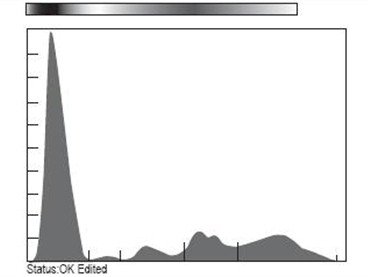 mieloma_multiple_gammapatia/electroforesis_proteinas_sericas mieloma_multiple_gammapatia/electroforesis_proteinas_sericas