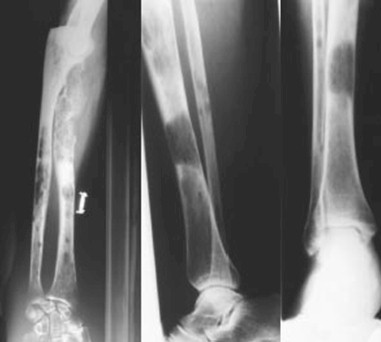 mieloma_multiple_gammapatia/lesiones_osteoliticas_radiologicas mieloma_multiple_gammapatia/lesiones_osteoliticas_radiologicas