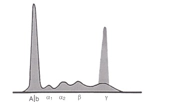 mieloma_multiple_gammapatia/monoclonal_proteinograma_maligno