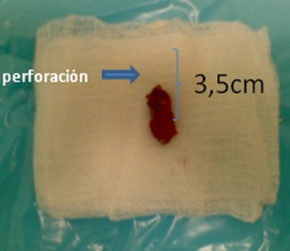 peritonitis_apendicitis_apendicular/perforacion_intestinal_caso peritonitis_apendicitis_apendicular/perforacion_intestinal_caso