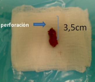 peritonitis_apendicitis_apendicular/perforacion_intestinal_caso