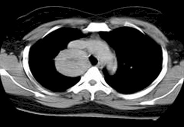 reseccion_fibrohistiocitoma_mediastino/masa_extrapulmonar_TAC