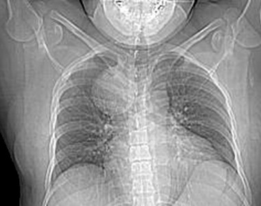 reseccion_fibrohistiocitoma_mediastino/tumor_mediastinico_masa