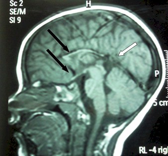 retraso_crecimiento_cerebral/agenesia_cuerpo_calloso