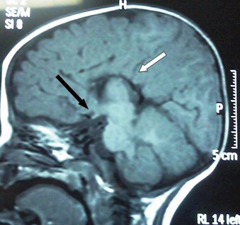 retraso_crecimiento_cerebral/ausencia_cuerpo_calloso